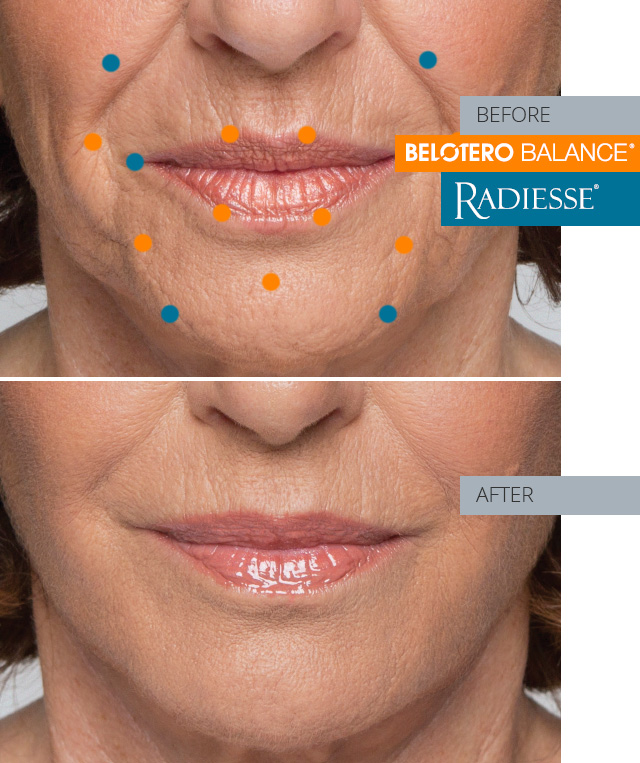 loraine  before and after combo treatment radiesse and belotero balance