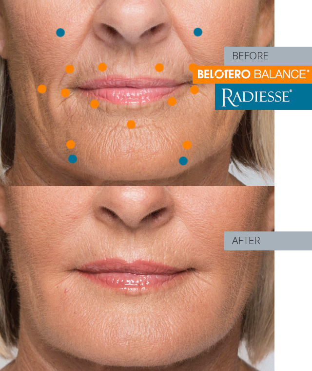 pam  before and after combo treatment radiesse and belotero balance