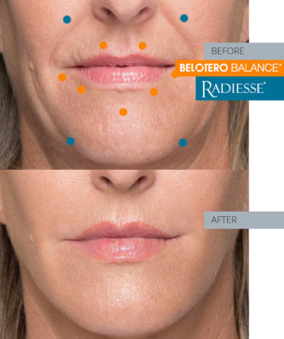 Combining RADIESSE® And BELOTERO® Fillers - Hayes Valley Medical Esthetics