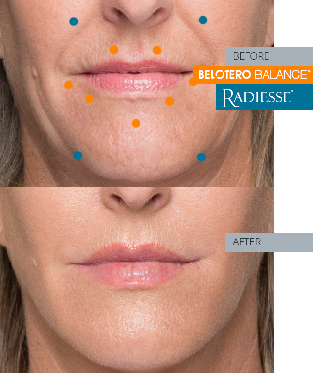 stephanie before and after combo treatment radiesse and belotero balance
