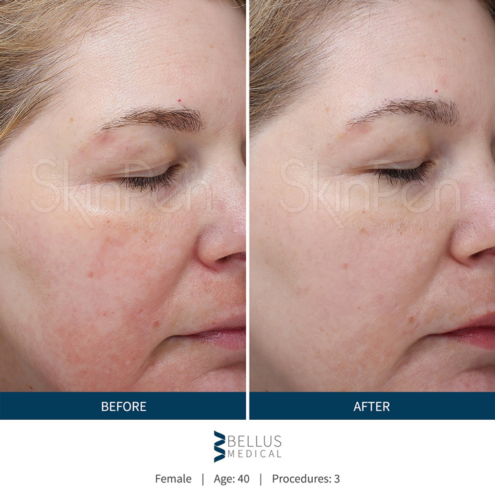 Microneedling Collagen Induction Therapy With Skinpen