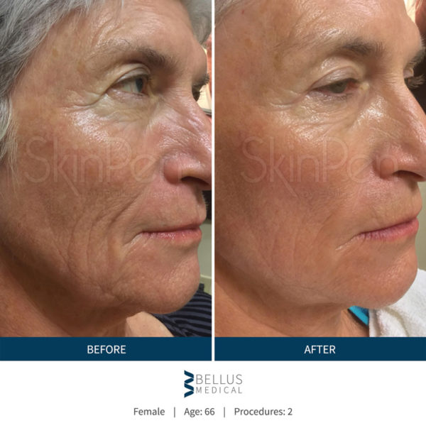 Microneedling Collagen Induction Therapy With Skinpen