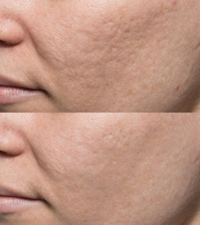 Bellafill® - The Only FDA-Approved Filler for Acne Scars - Hayes Valley ...