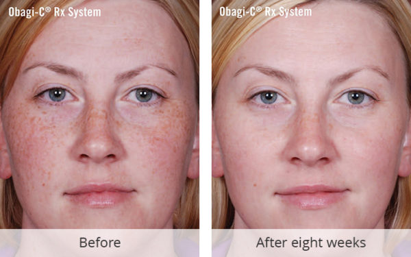 OBAGI-C RX Clarifying Serum Before and Afters - Hayes Valley Medical ...