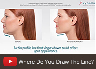 kybella-draw-the-line-video-how-it-works-thumb