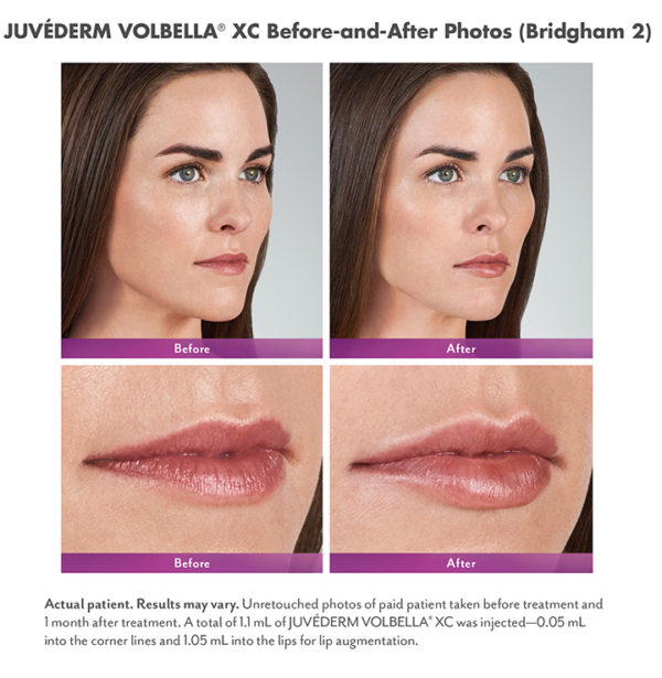 JuvÉderm Volbella® And JuvÉderm Voluma® Xc For Lips And Cheeks Hayes