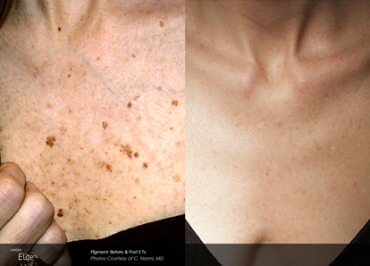 before and after chest pigment treatment