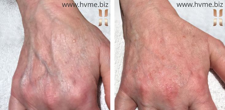 hvme before and after hand restylane lyft
