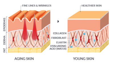 Scarlet RF Microneedling - Hayes Valley Medical Esthetics