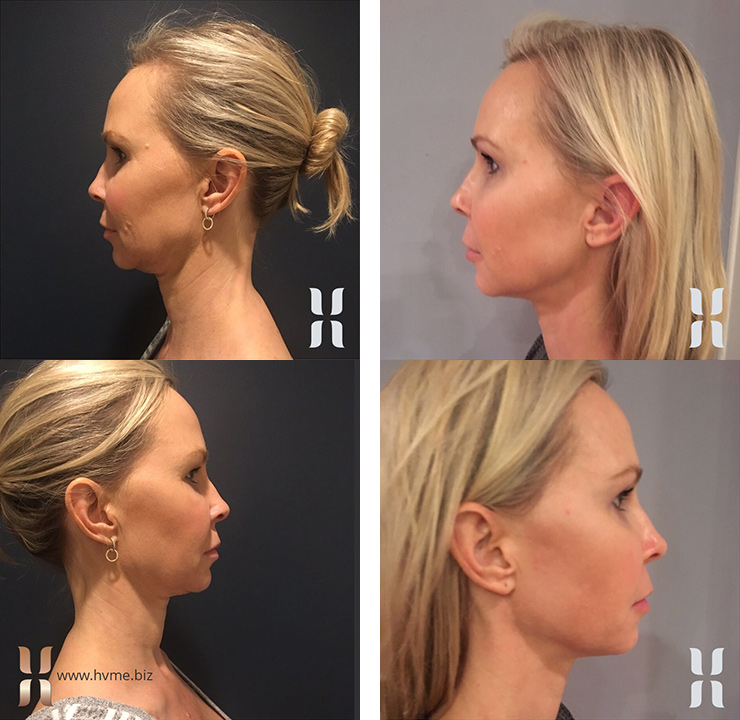 KYBELLA before and after 