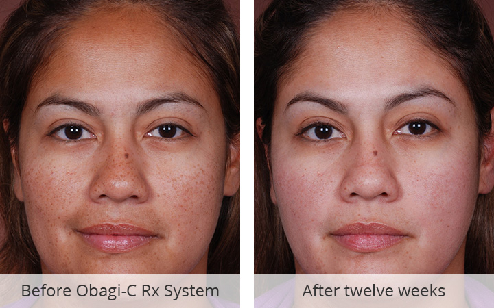 OBAGI-C RX Clarifying Serum Before and Afters - Hayes Valley Medical &amp;  Esthetics