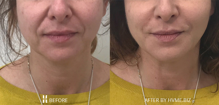 After treating nasolabial folds (marionette lines) with Radiesse
