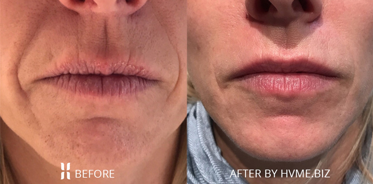 After treating lip and cheek area with Restylane Silk and Restylane Lyft