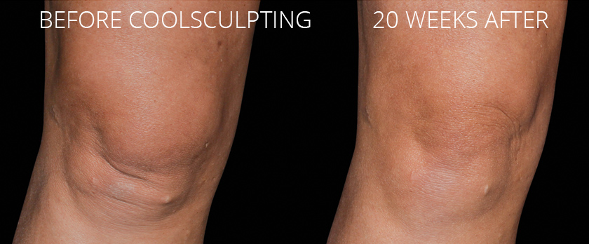 Treat Knee Fat Before and After