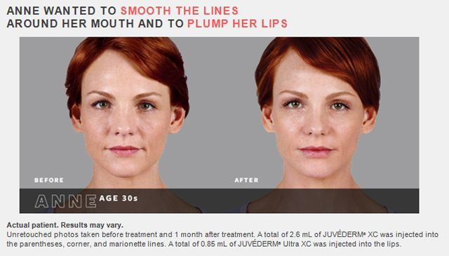 juvederm family of fillers before and after photos