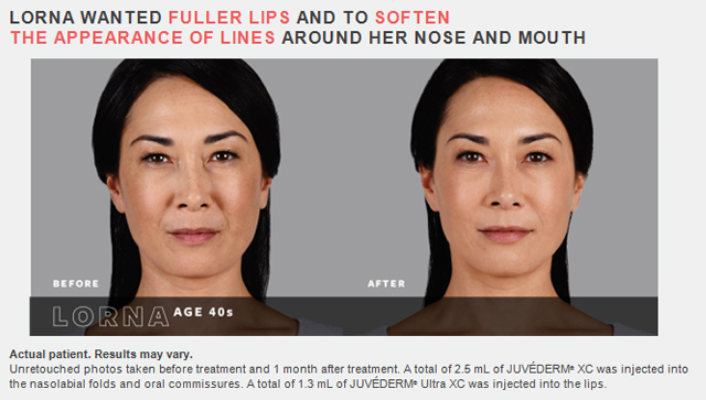 juvederm family of fillers before and after photos