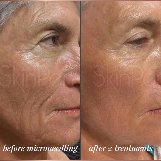 before microneedling and after two treatments