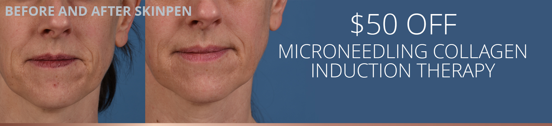 Microneedling Collagen Induction Therapy Special Offer