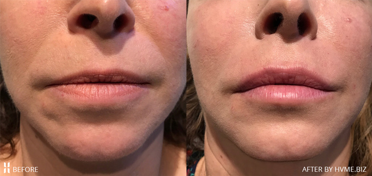 before and right after treatment with Volbella and Vollure