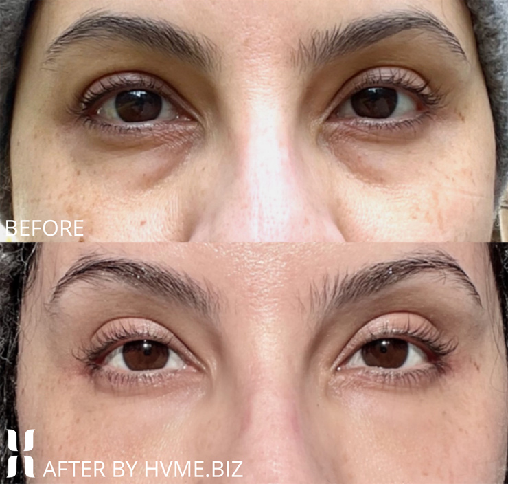 One month after Belotero Balance and Botox Cosmetic to treat tear trough