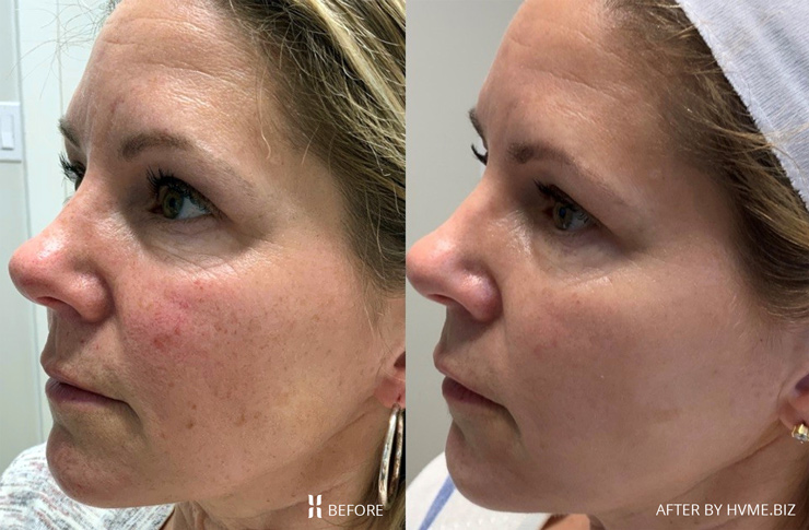 Three months after one Intense Pulsed Light treatment