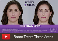 botox-twins-video-thumb