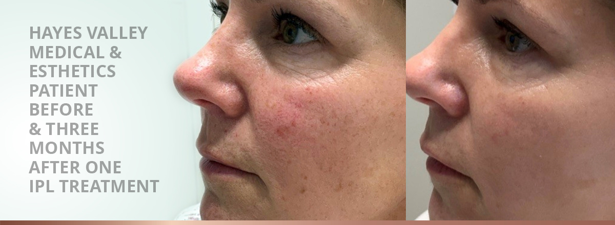 Intense Pulsed Light (IPL) before and after - Hayes Valley Medical and Esthetics