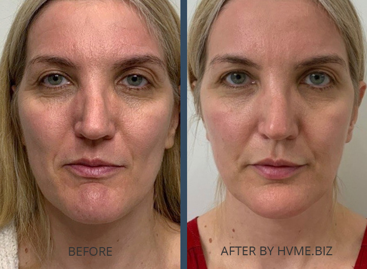 After two combo injectables treatments with Sculptra, Defyne, and Kysse