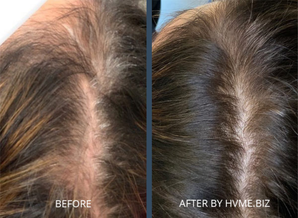 Hair Restoration with RF Microneedling, PRP and Exosome Serum - Hayes ...