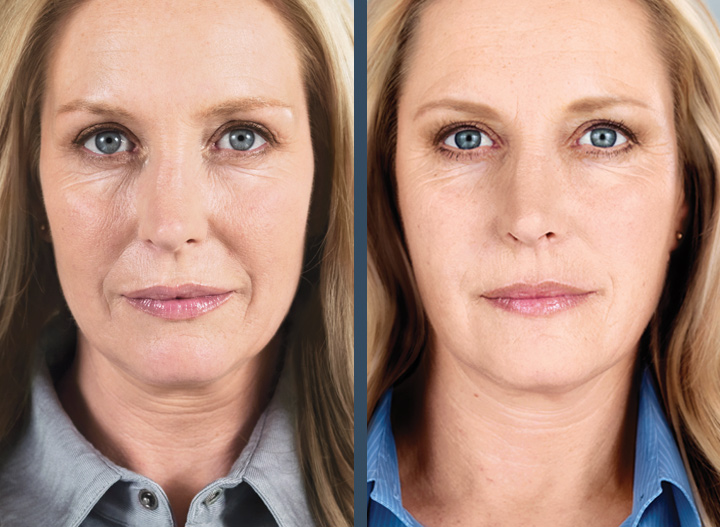 sculptra before and after photo
