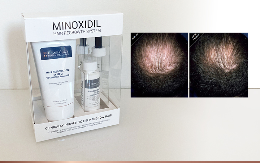 Mens Hair Regrowth with Minoxidil