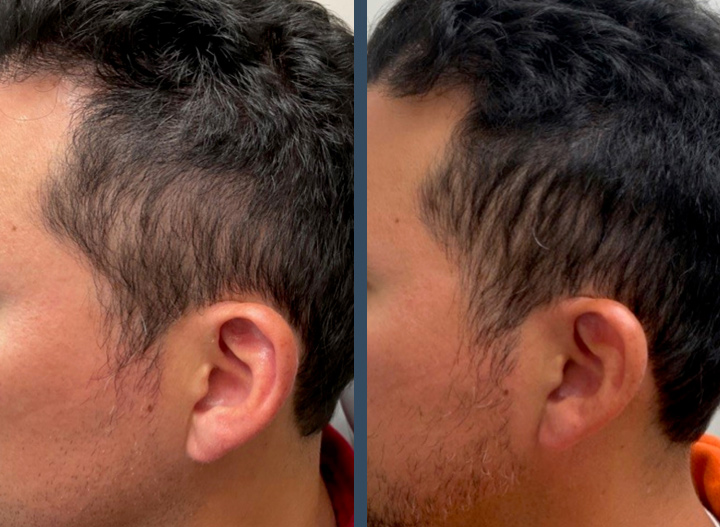 Hair Restoration with Scarlet RF and Exosomes