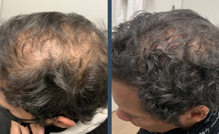 Hair Restoration with Scarlet RF and Exosomes