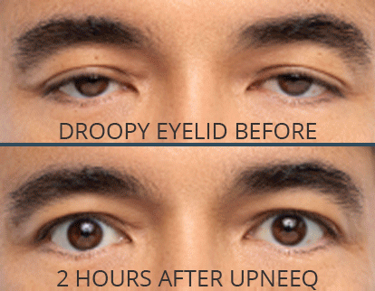 Upneeq for droopy eyelids (blepharoptosis)