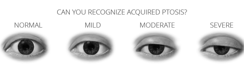 levels of acquired ptosis (droopy eye lids)