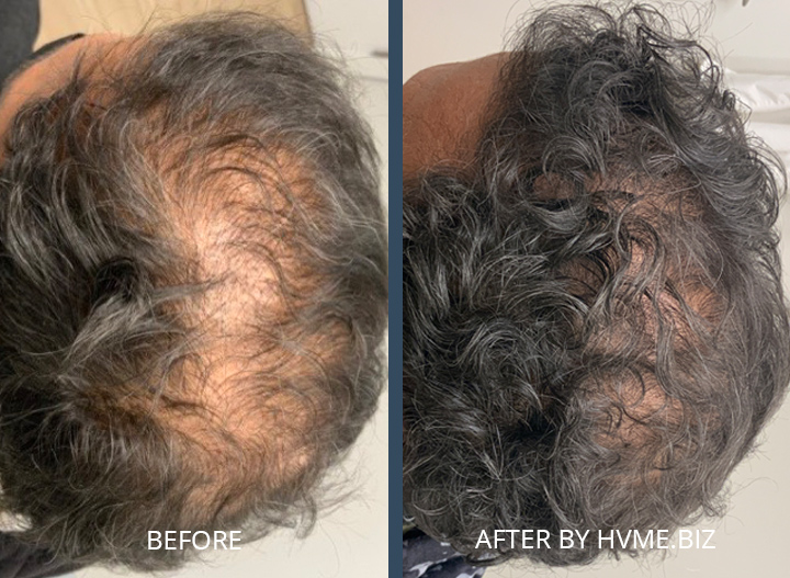 Hair Restoration with Exosome Serum - Hayes Valley Medical & Esthetics