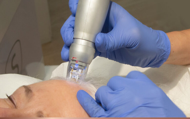 microneedling with radio frequency (RF) scarlet morpheus8 agnes.