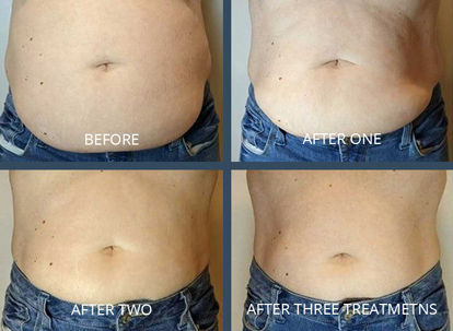 ultimate contour mens stomach before and after phots