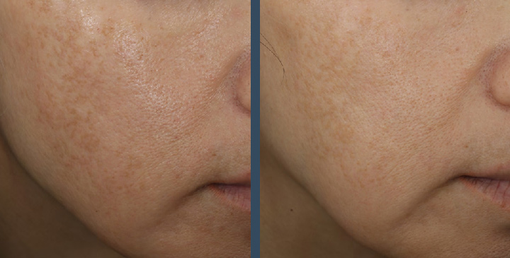 Before and after four weeks of using Even & Correct Advanced Brightening Treatment