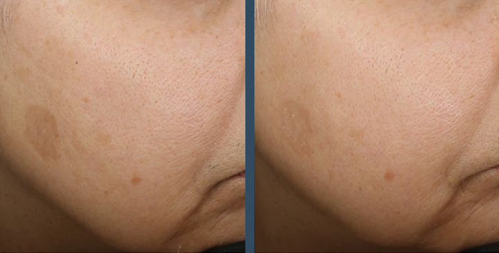 Before and after four weeks of using Even &  Correct Dark Spot Cream