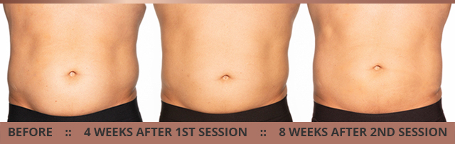 Coolsculpting Elite before and after photo