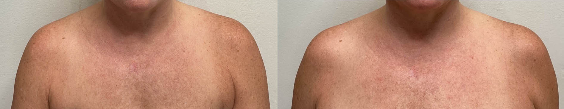 TrapTox before and after