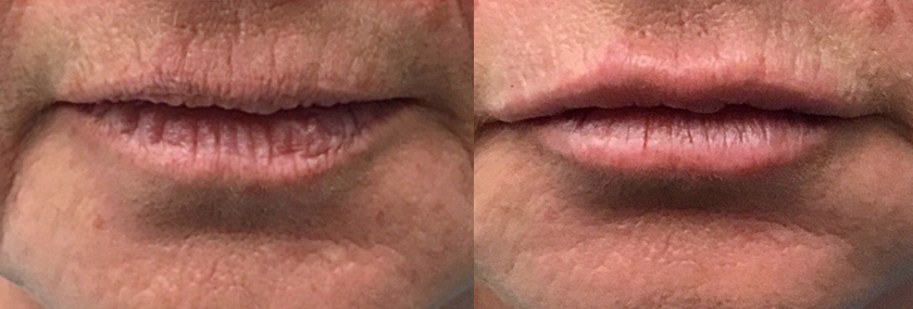 lip augmentation to enhance vermilion border