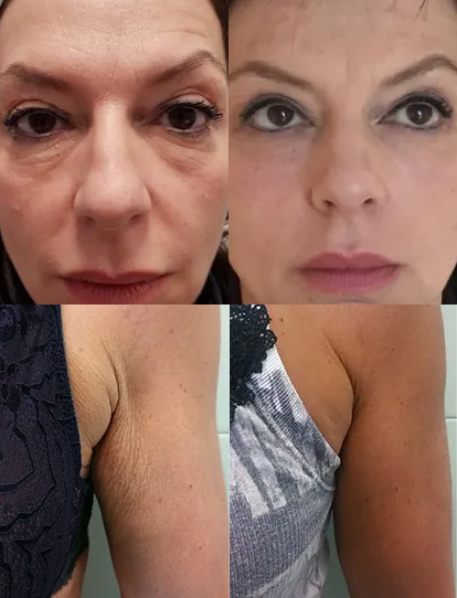 Attiva Radiofrequency (RF) before and after photos